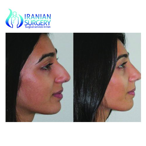 Iranian nose job before and afterfree nose job consultationIranian