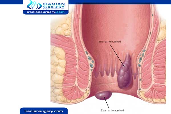أعراض البواسير الداخلية من الدرجة الأولی علاج البواسير الداخلية ايران سرجری