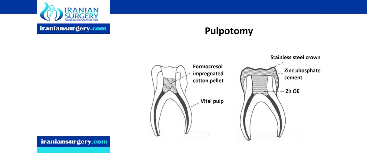 Pulpotomy | procedure | steps | Iranian Surgery