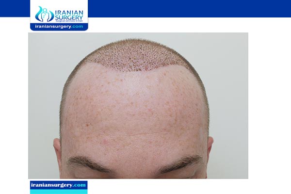 نتائج زراعة الشعر بعد 6 شهور ما هي نتائج زراعة الشعر بعد 6 شهور