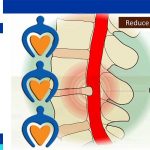 Herniated disk treatment IN IRAN
