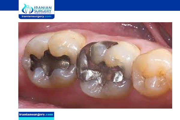 gic tooth filling