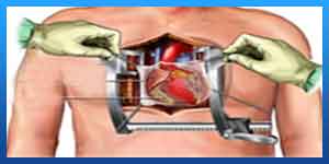 open heart surgery in iran