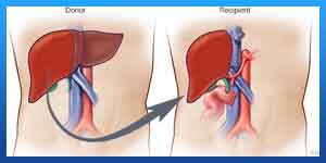 Types of Liver Transplant