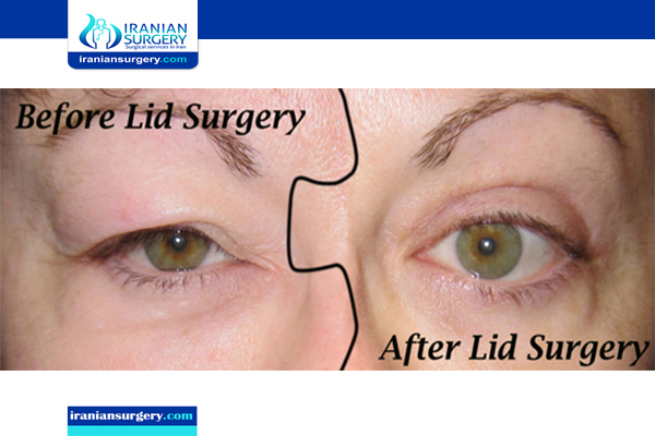 what does blepharoplasty mean