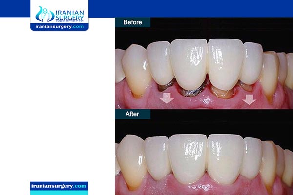 dental bridge images