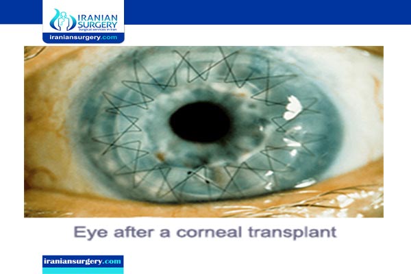corneal transplantation in iran