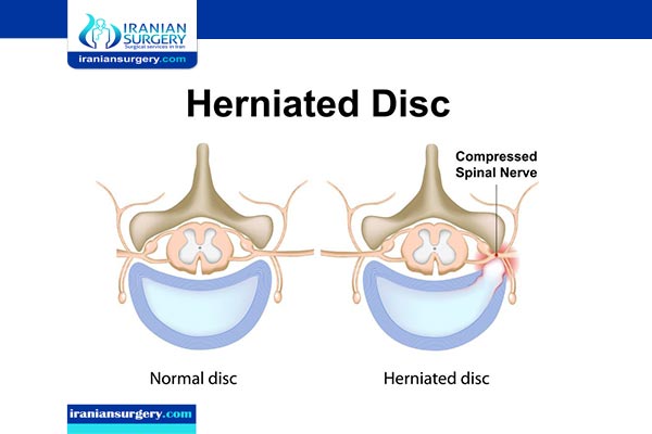 Herniated disk treatment in Iran | Herniated disc causes ...