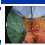 Posterior colpotomy procedure'