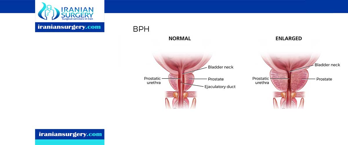 BPH treatment options