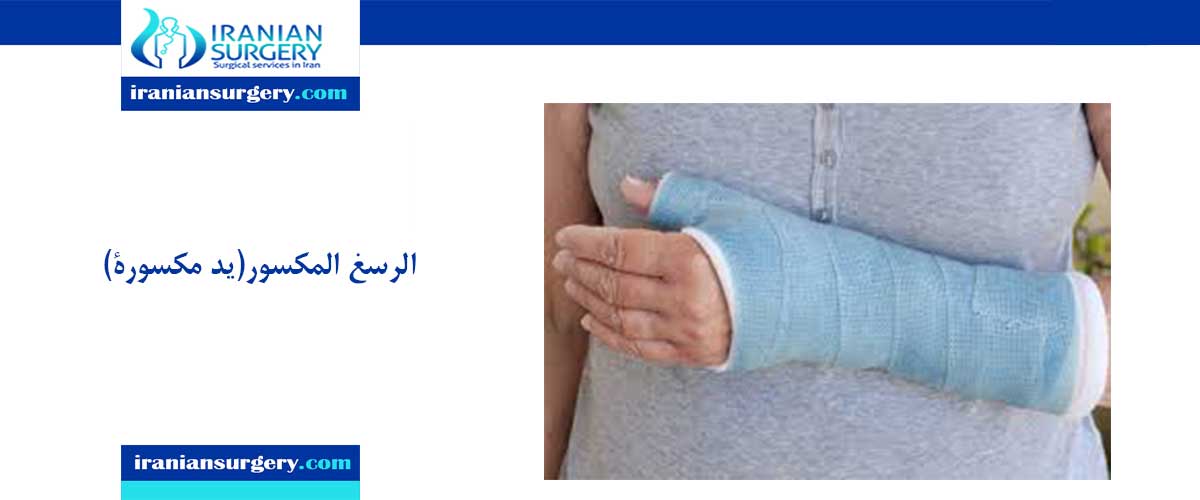 يد مكسوره كسر اليد علاج كسور اليد ذراع مكسورة الأسباب الأعراض ایرانیان سرجری