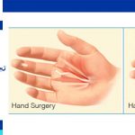 عملية تجميل اليدين في ایران