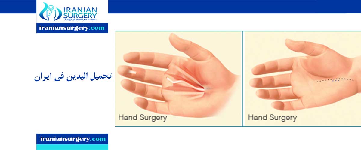 عملية تجميل اليدين في ایران