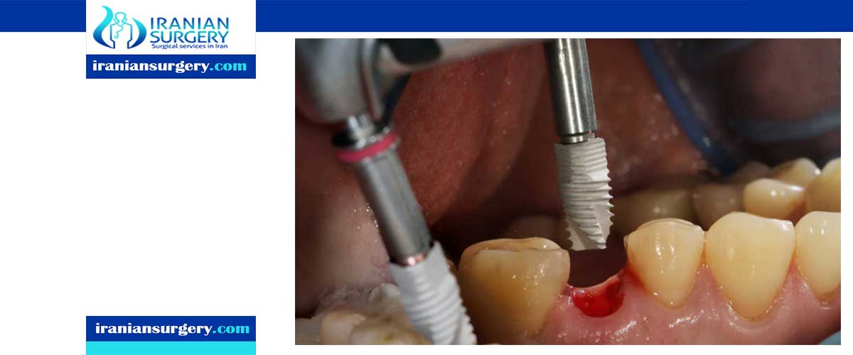 مخاطر زراعة الاسنان اضرار زراعة الاسنان مخاطر زراعة الاسنان الفورية مضاعفات زراعة الاسنان