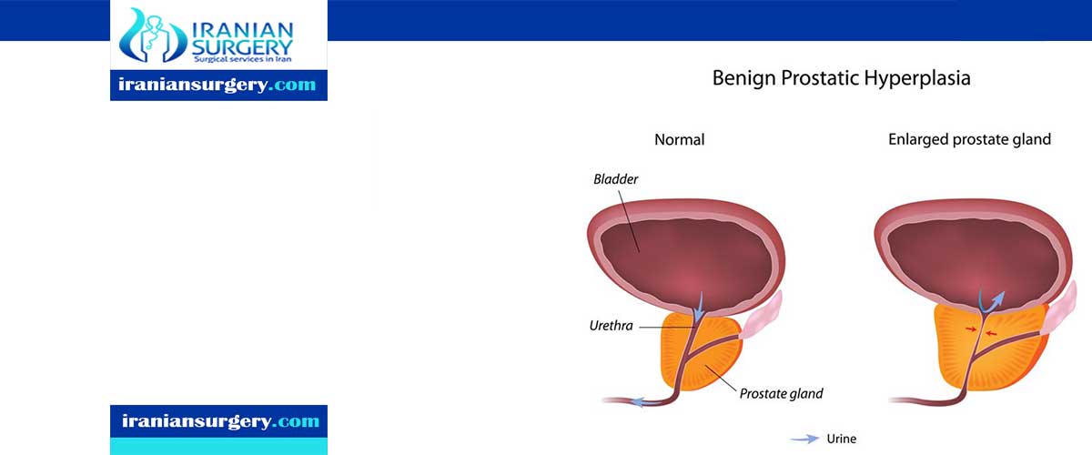 Benign prostatic hyperplasia(BPH)