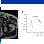 prostate biopsy in iran