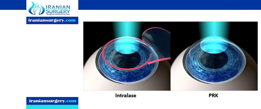 Intralase Lasik in iran