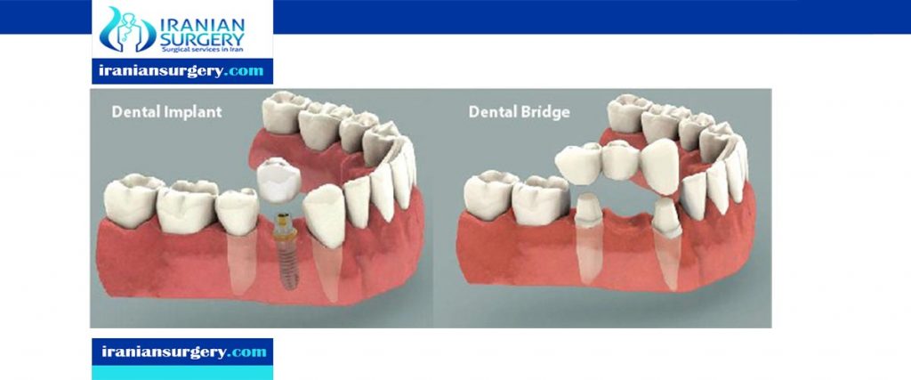 dental-implants-vs-crown-and-bridge-crown-or-implant-iranian-surgery