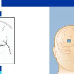 Moyamoya disease