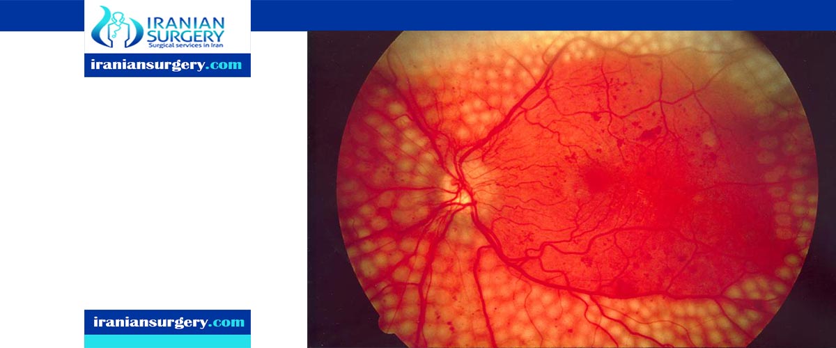 diabetic retinopathy treatment in iran