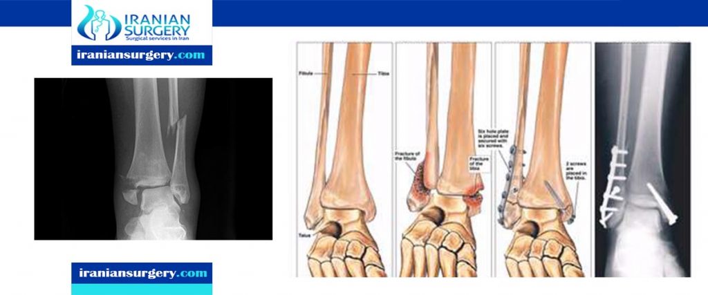 bimalleolar and trimalleolar ankle fractures