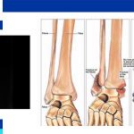 bimalleolar and trimalleolar ankle fractures