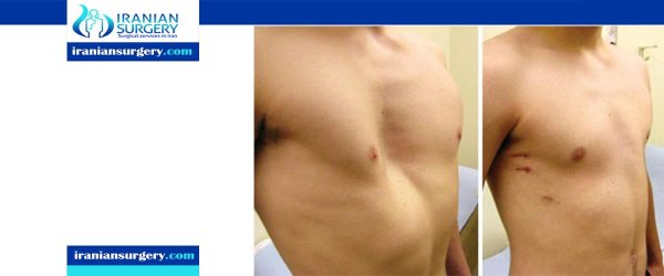 Chest Wall Deformities | Types of chest wall deformities | Iranian Surgery