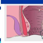 anal fistula