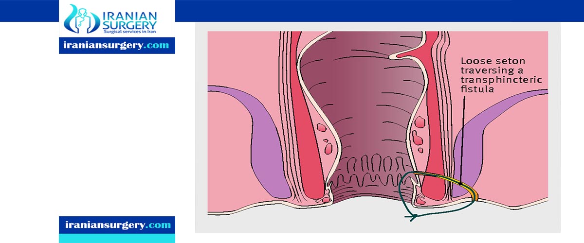 anal fistula