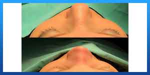 Rhinoplasty failure rate