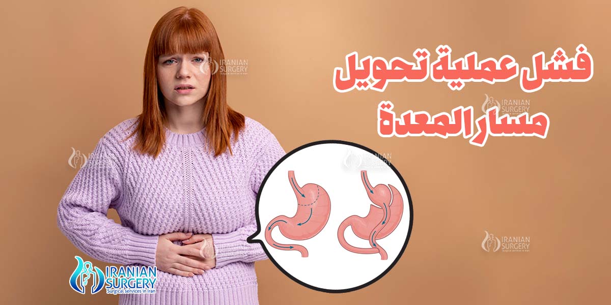 فشل عملية تحويل مسار المعدة