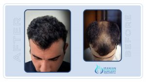 زراعة الشعر في ايران