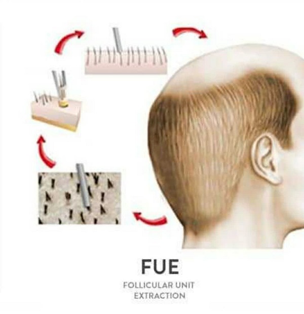 كيفية زراعة الشعر