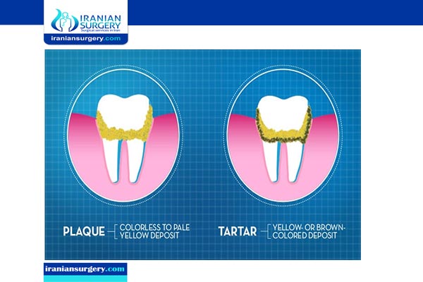 tooth cleaning in iran