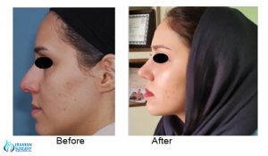 rhinoplasty in iran before and after