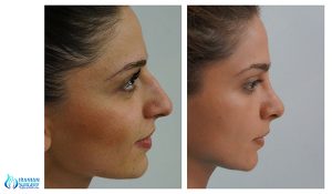 rhinoplasty in iran before and after