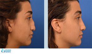 rhinoplasty in iran before and after