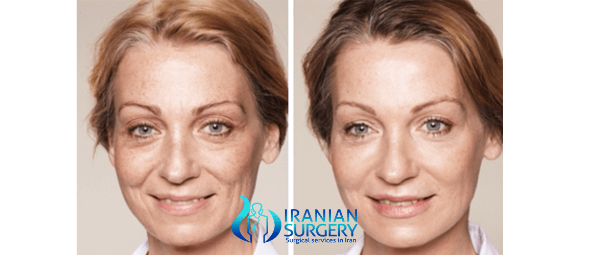 Botoxfiller injections restylaneradiesse