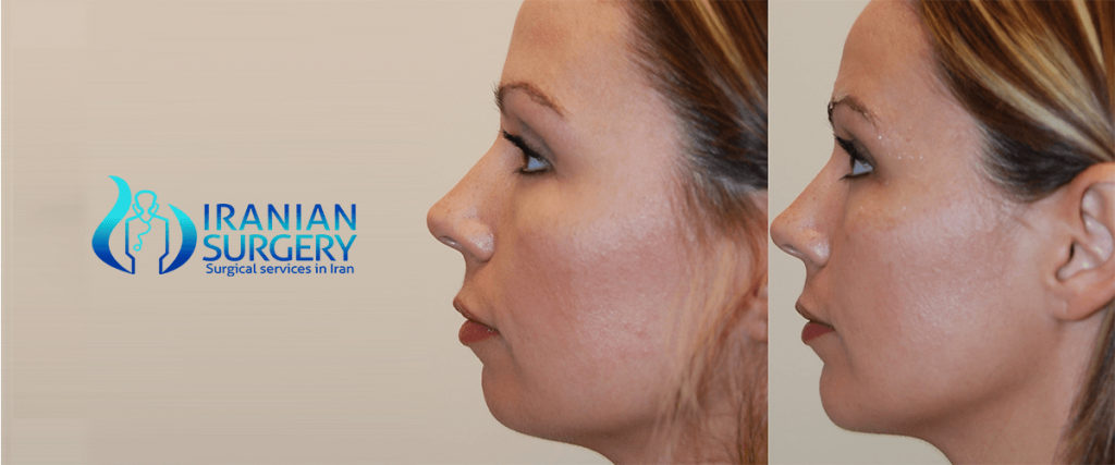 Chin, cheek, or jaw reshaping facial implants