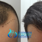 Hair replacement surgery