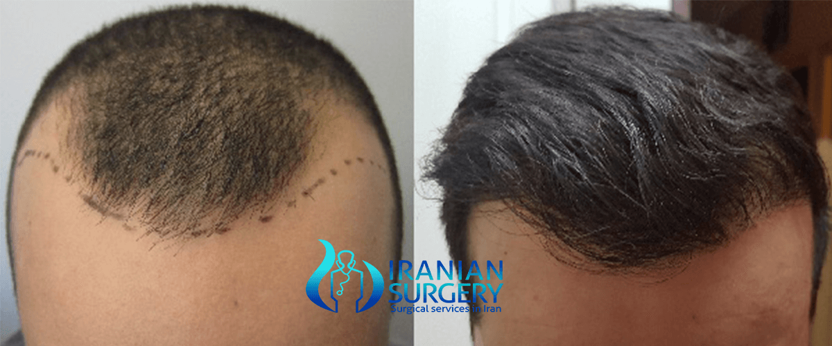 Hair replacement surgery cost | Hair transplant | Iranian Surgery
