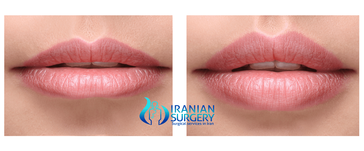 Lip augmentation Surgery