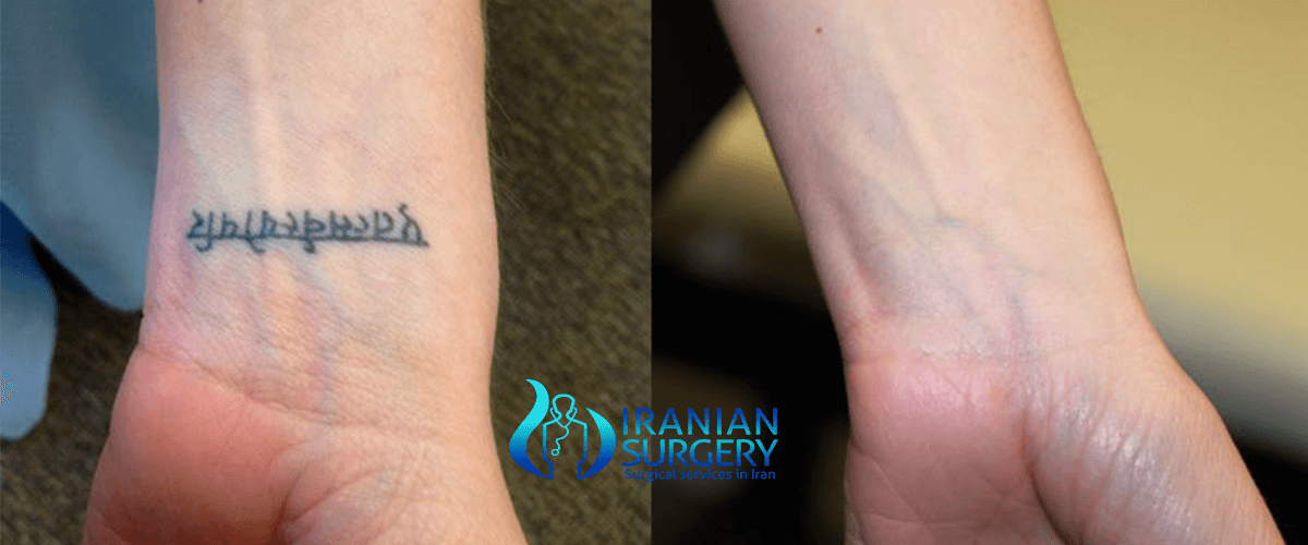 Tattoo removal surgery | plastic surgery tattoo removal | Iranian Surgery