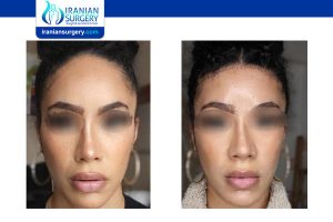 Latin ethci Rhinoplasty in iran