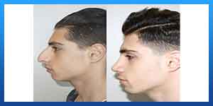 Difference between open and closed rhinoplasty