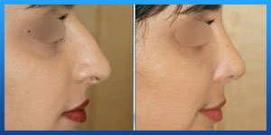 iranian nose job pictures