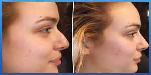 Non surgical Rhinoplasty before and after
