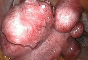 أعراض سرطان الرحم الحميد