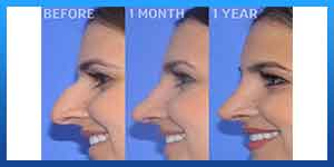 ethnic rhinoplasty in iran