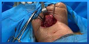 Submandibular Gland Surgery